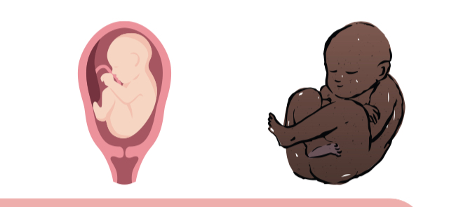 <p>Occurs when the fetus is positioned with  the buttocks or feet first instead of the head down at the time of  delivery. </p>