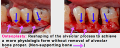 <p>Removal of non-supporting bone.</p><p>(Explanation: Osteoplasty removes bone not critical to tooth support (e.g., ledges) to create a smooth contour, improving gingival adaptation and reducing pocket depths.)</p>