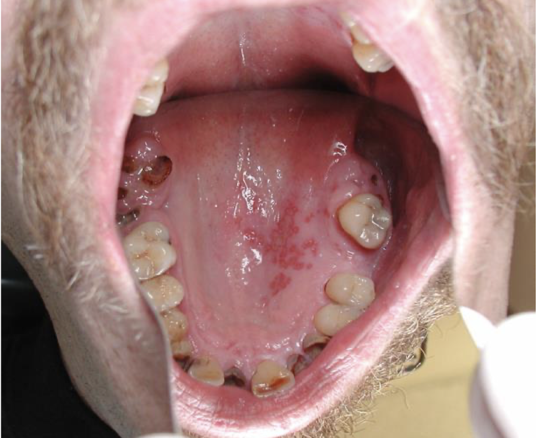 <p>what virus is this lesion associated with and how do you determine?</p>