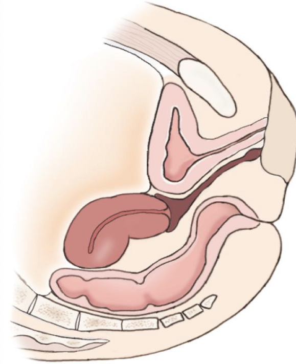 <p>fundus &amp; body bent backward toward the cervix</p><p></p>