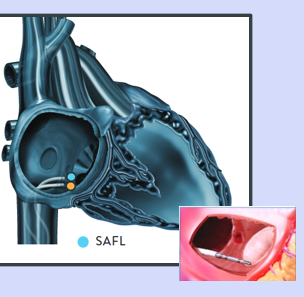 <p>SAFL (right sided)</p>