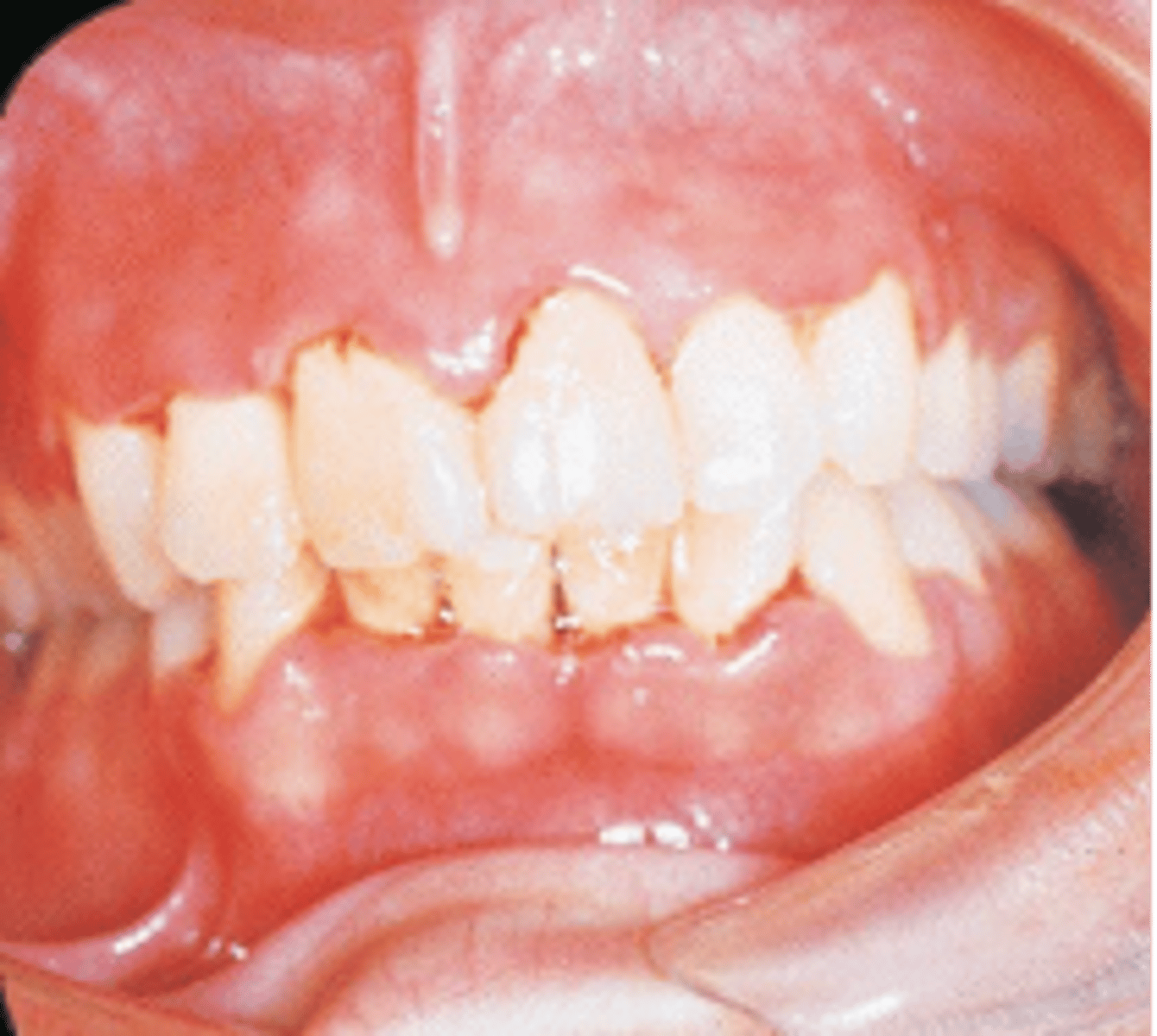 <p>Fusiform bacillus and Spirochete cause this, cratered papilla, and white tissue because of cell death</p><p><span>This patient presents with painful, erythematous gingiva and the interdental papillae appear as punched-out, necrotic, cratered areas. Sloughing of necrotic tissue presents as a pseudomembrane over the tissues. What condition do you suspect?</span></p>
