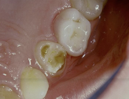 <p>enamel can be white, yellow, brown, and or have different degrees of hypoplasia; most commonly in bicuspid because of their relation ship with the deciduous molars; causes fever, PA inflammatory disease of overlying deciduous tooth, trauma</p>