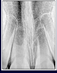 <p>-replant and observe</p><p>-open apex = chance for revascularization to occur</p>