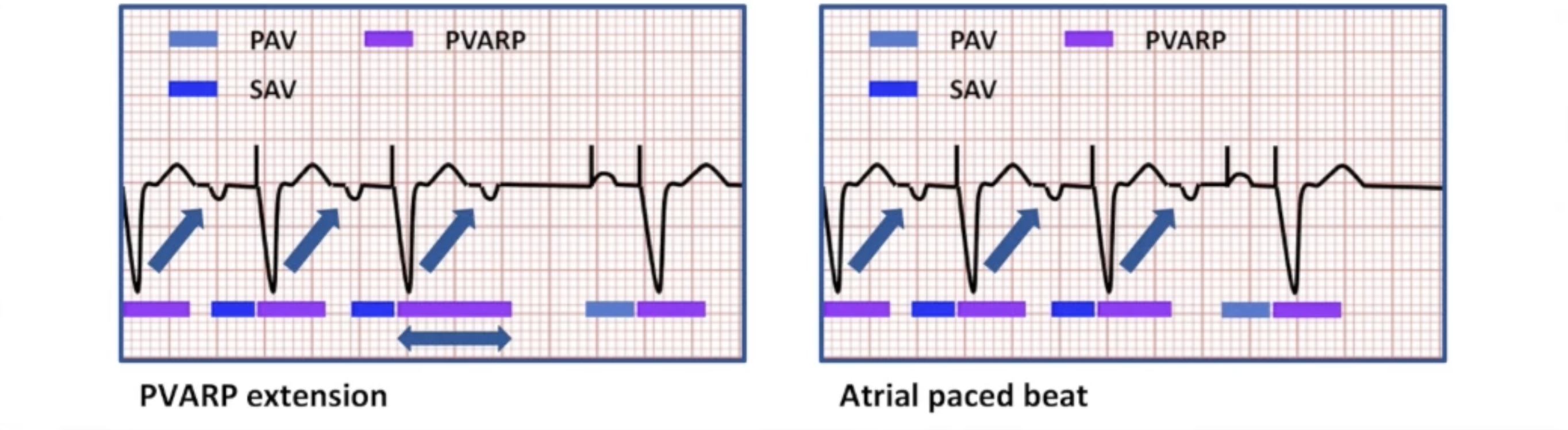 <ul><li><p>Look for specific number of P waves tracked at MTR</p></li><li><p>Extend PVARP for one interval</p></li><li><p>Alternative: deliver atrial paced beat</p></li><li><p>VA stability: alternative for PTM below MTR</p></li></ul><p></p>