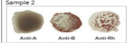 <p>What blood type is this?</p>