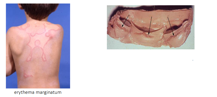<p>ACUTE RHEUMATIC FEVER:</p><p>- Common in aboriginal children, and worldwide associated with poverty</p><p>- Syndrome including arthritis, rash, writhing movements and carditis</p><p>.</p><p>- carditis: damage to heart valves and muscle</p><p>- recurrent rheumatic fever leads to rheumatic heart disease years later</p><p>- Chronic narrowing or stiffness of heart valves</p>