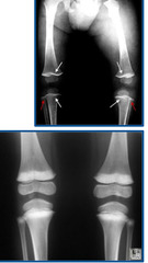 <p>What is accumulating at the end of the long bones in this cow?</p>