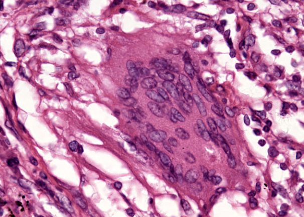 <p>Tuberculosis</p>