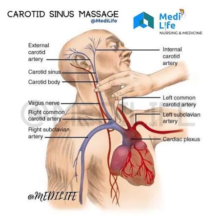 <p>Carotid Sinus massage</p>