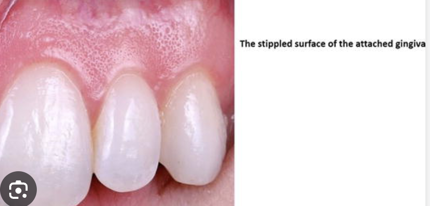 <p>healthy: Stippled or smooth</p><p>diseased: Smooth and shiny</p>