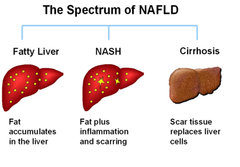 <p>exercise helps prevent fatty liver</p>