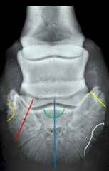<p>Which color is a type 3, articular mid-sagittal fracture?</p>