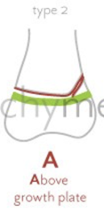 <p>fracture through physis, oblique fracture of metaphysis</p>