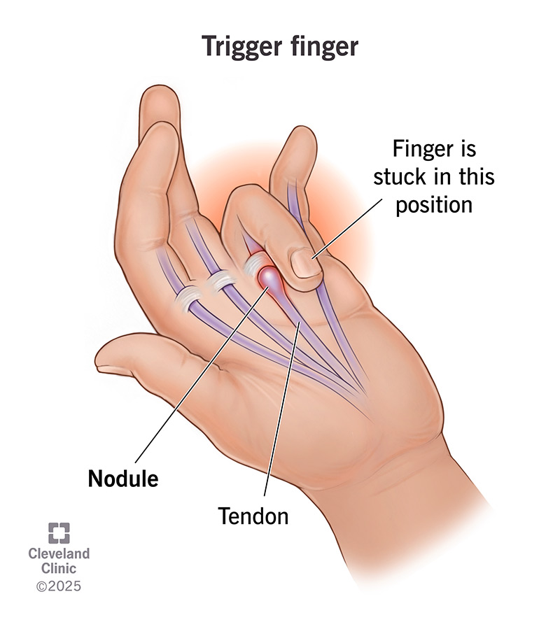 <ul><li><p>A nodule on the flexor tendon sheath and stenosis at the A-1 pulley causing "locking" or "snapping" during resisted grip</p></li><li><p>Pain present over A1 pulley</p></li></ul><p></p>