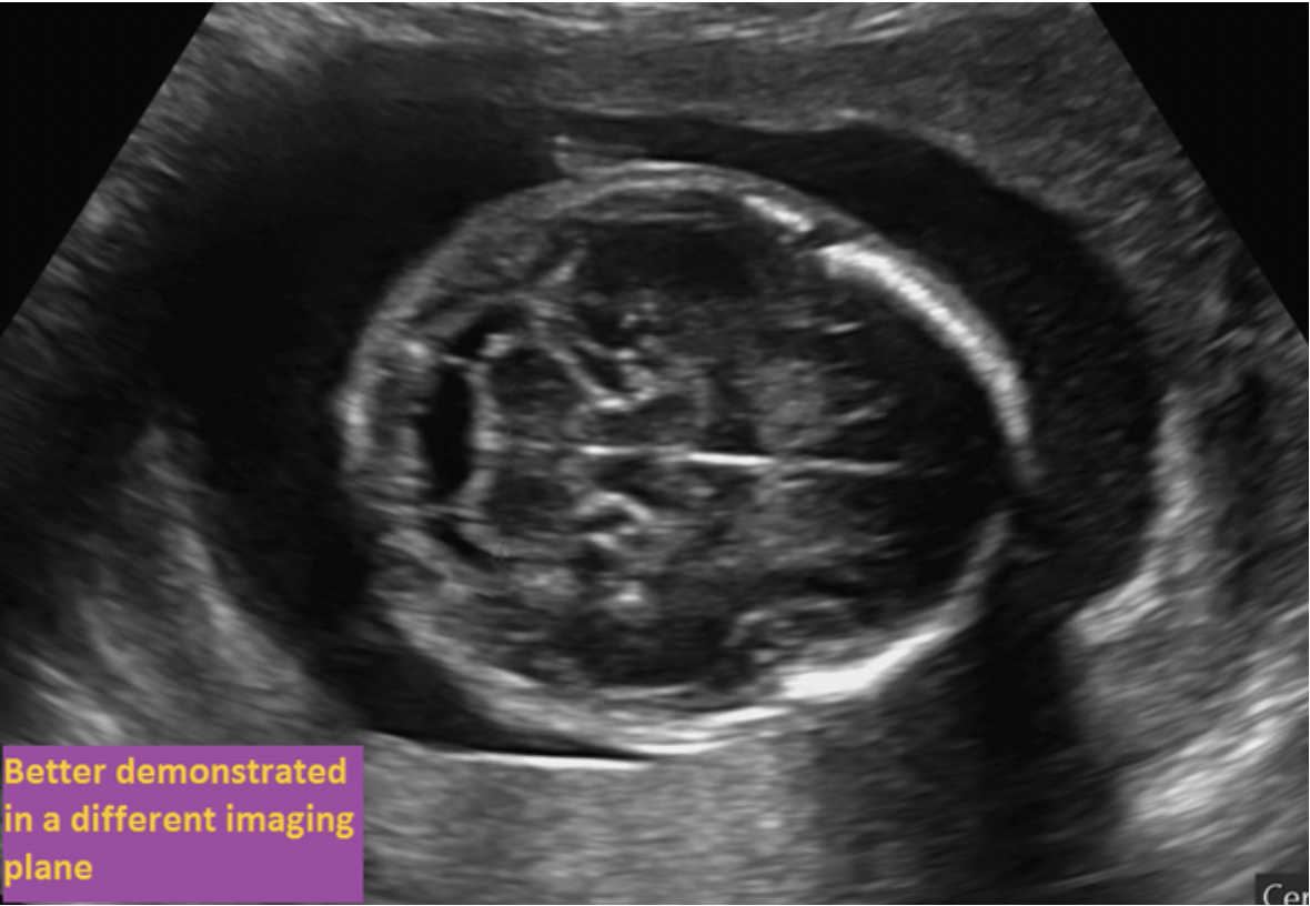 <p>If the fetus is in breech position, where is the left lobe of the cerebellum located? If the structure is normally evaluated in a different imaging plane, select the purple box.</p>