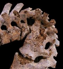 <p>creates bone caries and localized destruction of bone; Can lead to spinal collapse called tuberculous spondylitis</p>