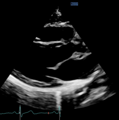<p>Parasternal Long Axis (PLAX)</p>