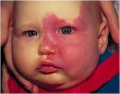 <p>Skin and meningeal angiomatous lesions. Port-wine nevus: skin angioma in ophthalmic division of trigeminal nerve. Pial angiomas may result in chronic ischemia, gliosis, and gyral cortical calcifications. Enlargement of deep and subependymal veins may mimic arteriovenous malformations.</p>