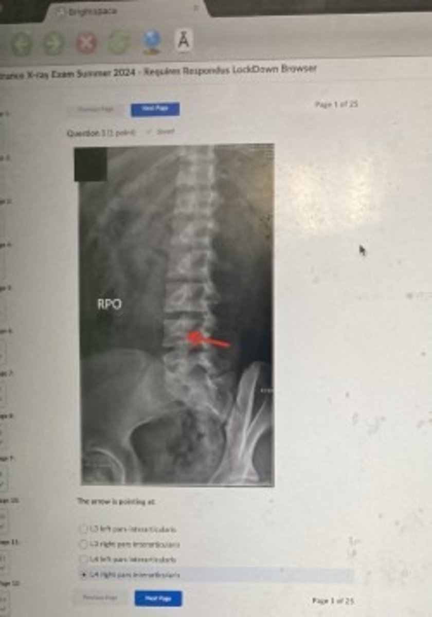 <p>L4 Right pars interarticularis</p>