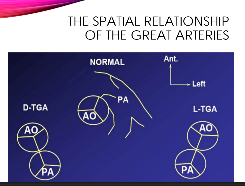 <p>•A – Anterior; aortic valve directly anterior to pulmonic valve.</p>