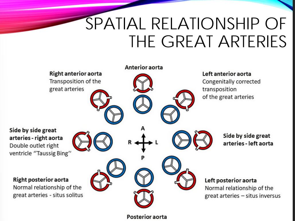 <p>S- Solitus; (normal) aorta is rightward and posterior to pulmonic valve</p>