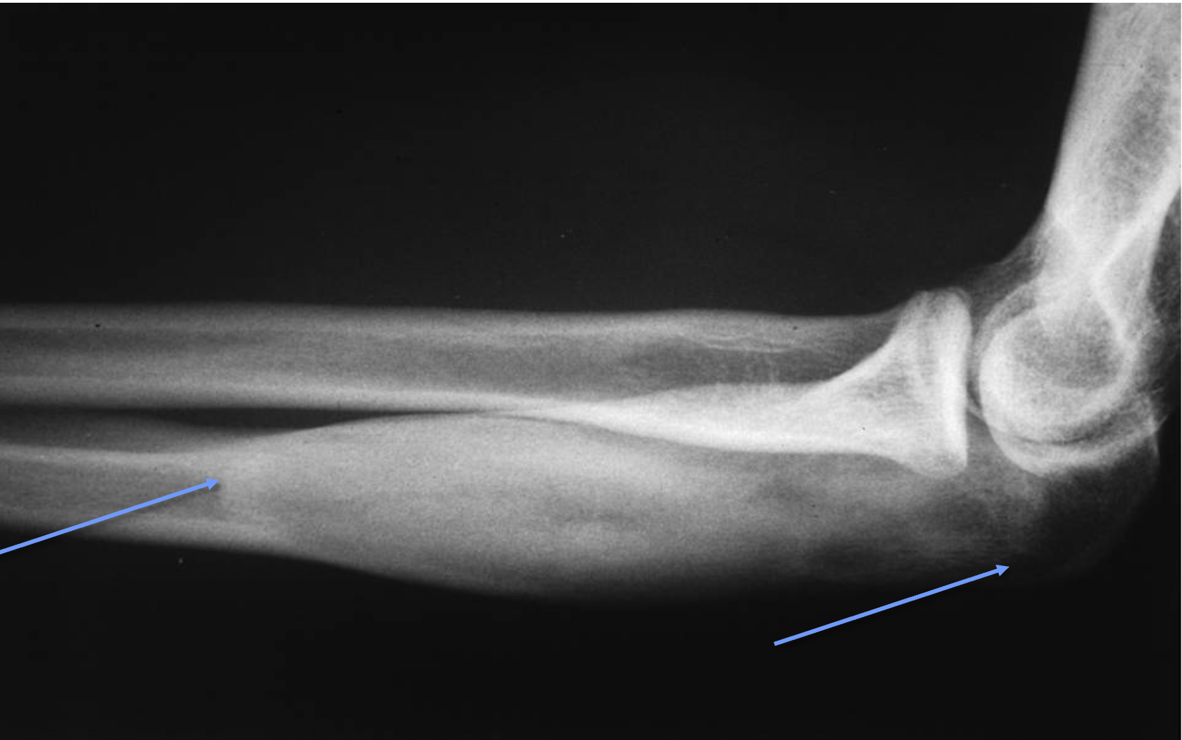 <p>What tumour like disorder is this, what can you see?</p>