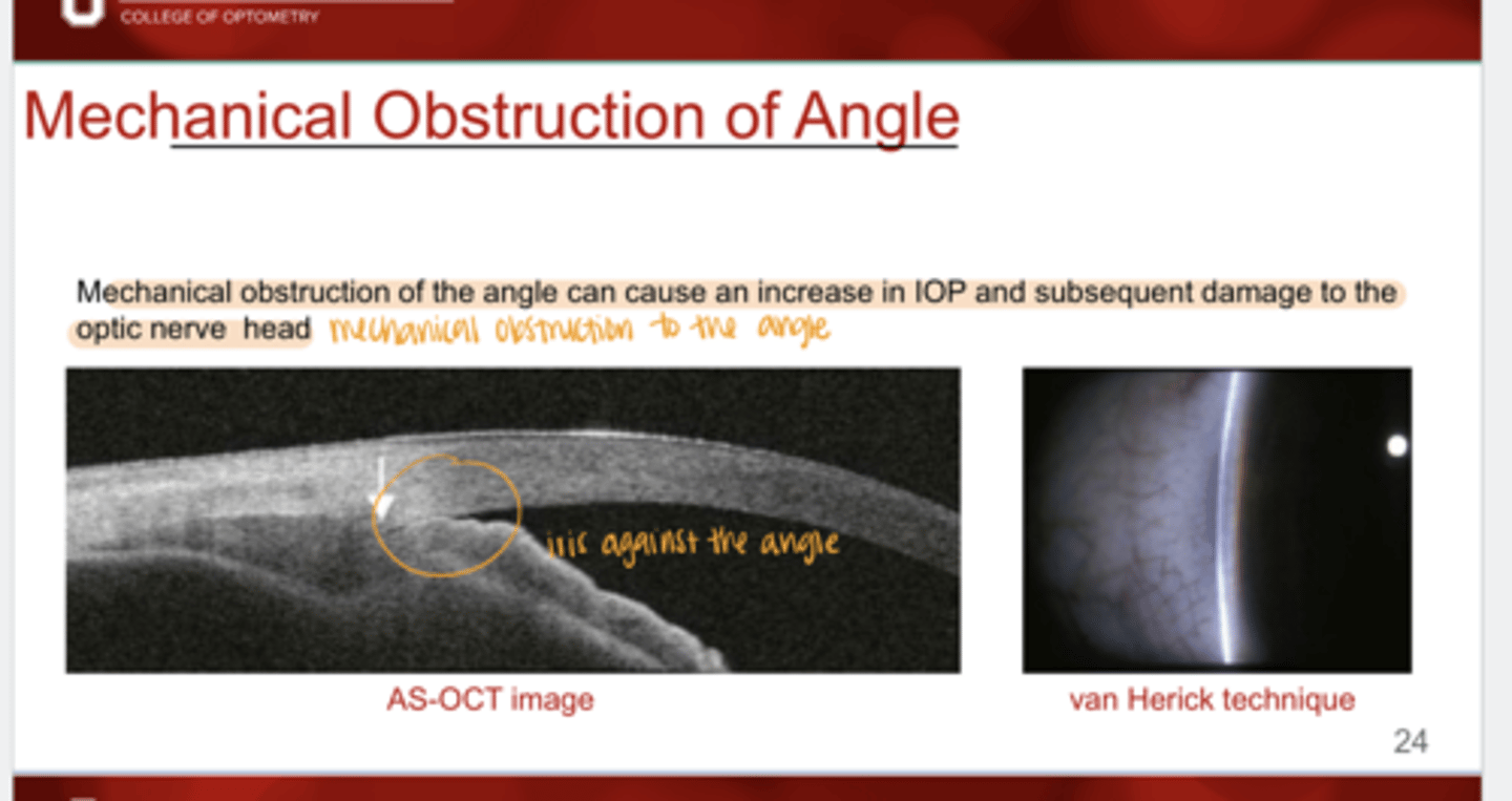 <p>What can mechanical obstruction of the angle cause?</p>