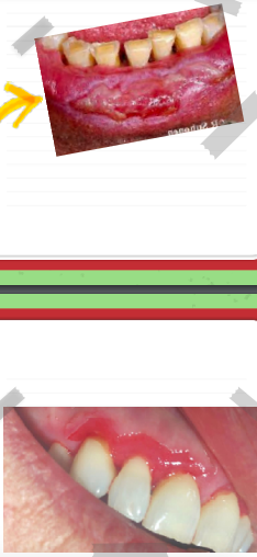 <p>lichen planus</p><p>desquamative gingivitis</p>