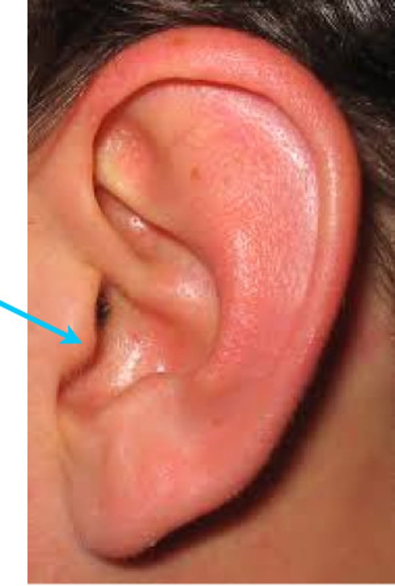 <p>The small, rounded, fleshy bulge that lies immediately anterior to the ear canal.</p>