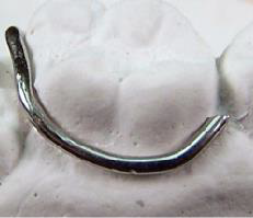 <p>ID the type of clasp:</p>