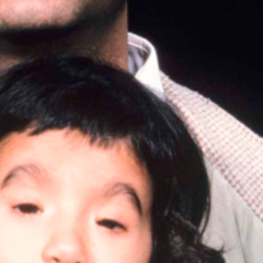 <p>AD at FOXL2. narrow eyes, droopy eyelids, an upward fold of skin of the inner lower eyelids and widely set eyes. BPES type I is also associated with loss of ovarian function or premature ovarian insufficiency (POI)</p>