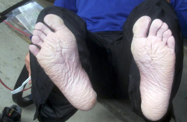 <ul><li><p>swollen and softened by an increase in water content</p></li><li><p>ex) when your skin get wrinkly after being in the pool</p></li></ul><p></p>