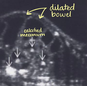 <ul><li><p>fluid-filled, dilated colon</p></li><li><p><span style="color: red;">calcified meconium</span></p></li><li><p>normal AFI</p><ul><li><p>can be decreased if renal problems are present</p></li></ul></li></ul><p></p>