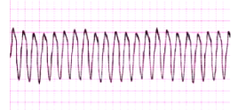 <ul><li><p class="Paragraph SCXW208490239 BCX8" style="text-align: left;"><span style="line-height: 20.85px;">Cause: MI, CAD, Electrolyte imbalances, Cardiomyopathy, Mitral valve prolapse, Long QT syndrome, Digitalis toxicity, Central nervous system disorders </span></p></li></ul><ul><li><p class="Paragraph SCXW208490239 BCX8" style="text-align: left;"><span style="line-height: 20.85px;">Tx: Precipitating causes must be identified and treated (e.g., hypoxia), B-Adrenergic blockers, lidocaine, amiodarone, IV magnesium, lidocaine, Drugs that prolong the QT interval should be discontinued, If the rhythm is not converted, cardioversion may be needed, VT without a pulse is a life-threatening situation, Cardiopulmonary resuscitation (CPR) and rapid defibrillation, Epinephrine, amiodarone, or lidocaine if defibrillation is unsuccessful </span></p></li></ul><p></p>