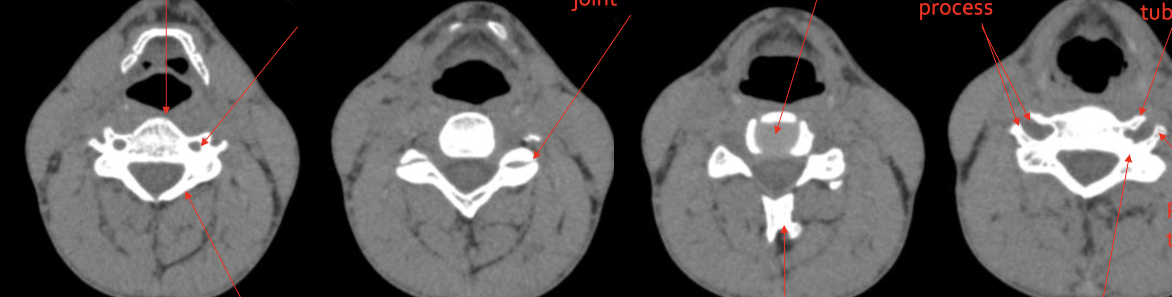 <p><span>椎间盘</span></p>
