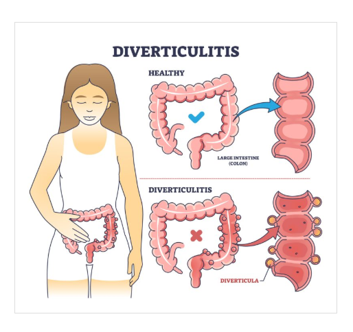 <p>Diverticulitis</p>