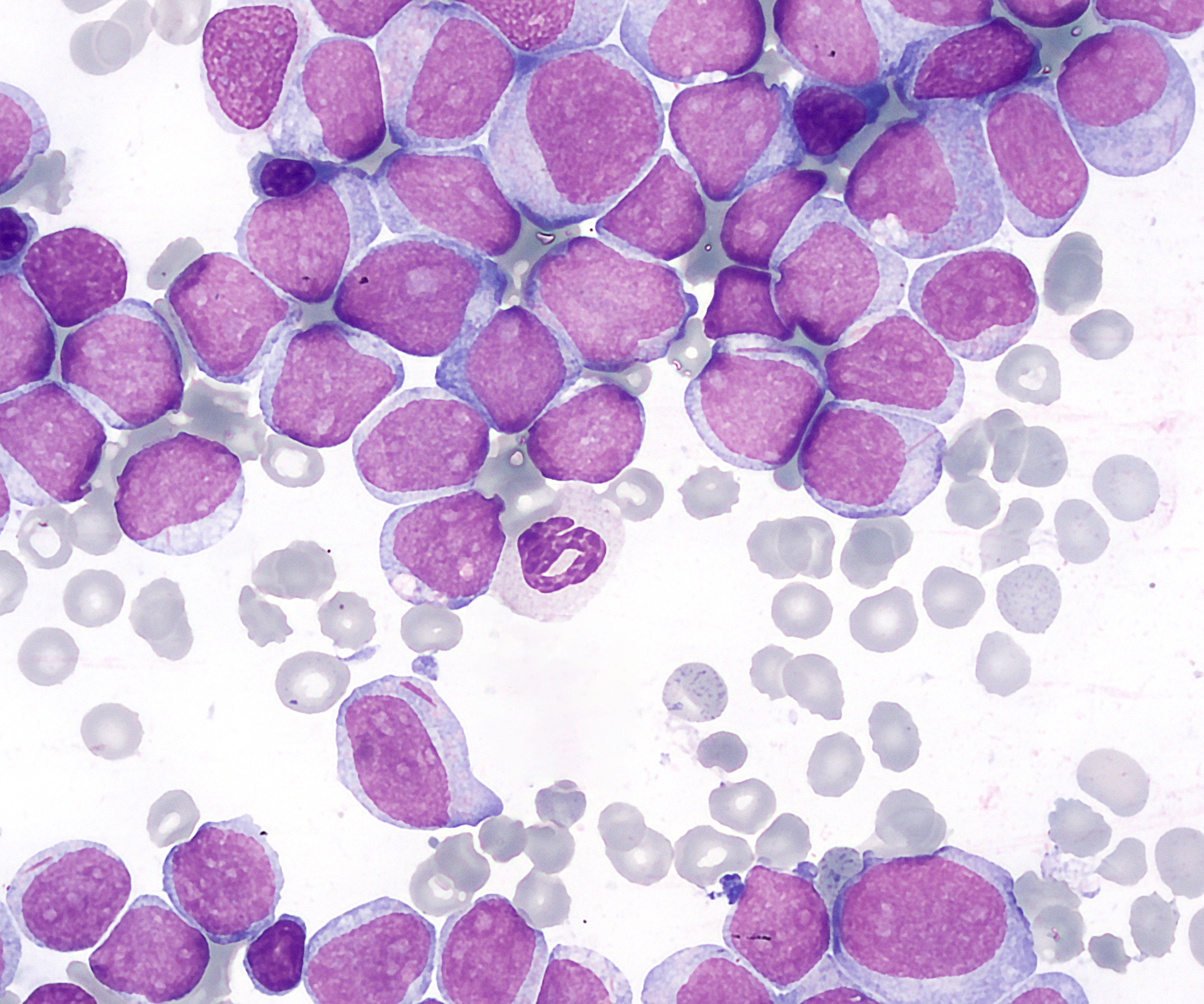 <p>ACUTE LEUKEMIA</p>