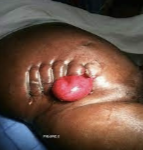 <p>Wound edges seperated as well as organ pertruting out the body </p>