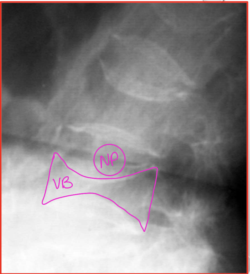 <p>What is a DDX of codfish vertebra deformity </p>