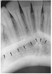 <p>Radiopaque line in anterior mandible</p>