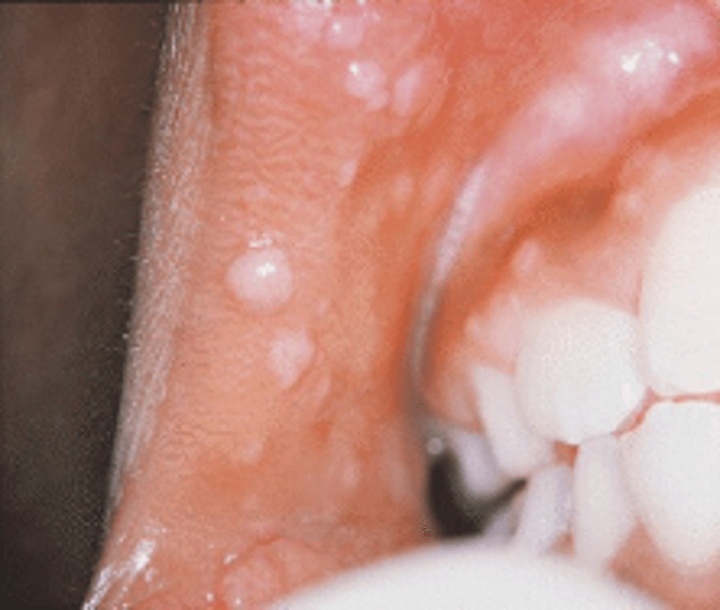 <p><br>is a cutaneous condition characterized by white to pinkish papules that occur diffusely in the oral cavity. It is caused by the human papilloma virus types 13 and 32.</p><p><span>This condition is referred to as Heck disease or multifocal epithelial hyperplasia, is most common in children, and infrequently seen in patients with HIV. What is the etiologic agent for this condition?</span></p>