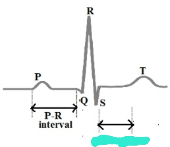 <p>QRS complex의 S 끝단부터 T wave 구간</p><p>-baseline보다 높아졌는지 보는게 핵심</p>