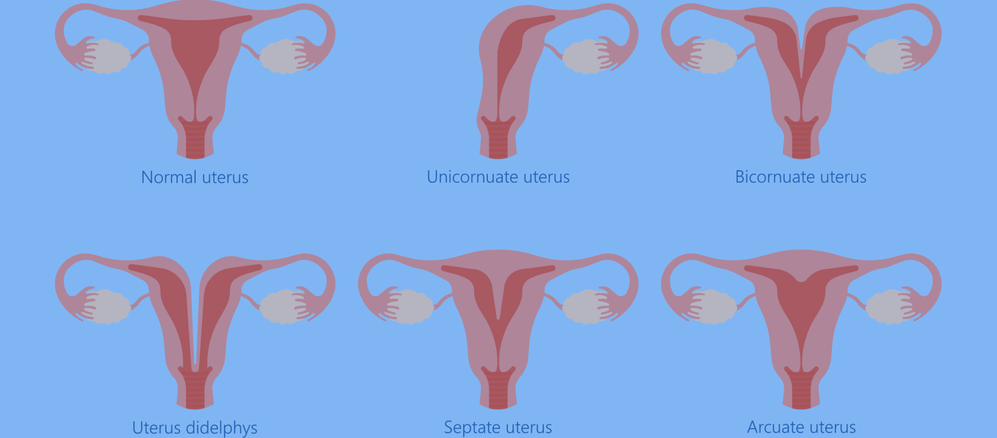 <p>Structural malformations of the uterus occurring during fetal development when the Müllerian ducts fail to properly fuse, affecting approx. 5% of women</p><p>Often asymptomatic, but can cause infertility, recurrent miscarriage, preterm birth</p><p><strong><u>Types of Malformations</u></strong>:</p><ul><li><p><span><strong>Septate Uterus </strong>(<em>Most Common</em>)<strong>:</strong> A partition (septum) divides the uterus into two parts, though the external shape is normal</span></p></li><li><p><span><strong>Bicornuate Uterus</strong> (<em>"Heart-shaped")</em><strong>:</strong> The uterus has an abnormal, indented top, creating two distinct cavities</span></p></li><li><p><span><strong>Uterus Didelphys </strong>(<em>"Double Uterus"</em>)<strong>:</strong> The Müllerian ducts fail to fuse at all, resulting in two separate uteri and often two cervices</span></p></li><li><p><span><strong>Unicornuate Uterus:</strong> Only one side of the uterus develops fully</span></p></li><li><p><span><strong>Arcuate Uterus:</strong> A minor variant with a slight indentation at the top, usually considered a minor anatomical variation.</span></p></li><li><p><span><strong>Absent Uterus </strong>(<em>Müllerian Agenesis</em>): Uterus fails to develop</span></p></li></ul><p></p>