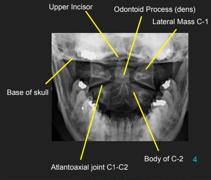 <ul><li><p>Entire odontoid process, atlantoaxial joint, and lateral masses of C1 demoed</p></li><li><p>Upper incisors and base of skull are superimposed</p></li><li><p>Atlantoaxial joint is symmetrical</p></li></ul><p></p>