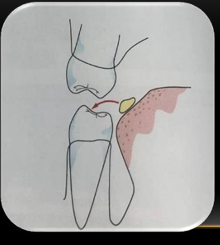 <p>-lingual inclination of the lower posterior teeth positions the lingual cusps lower than the buccal cusps</p><p>-allows the tongue to position food on the occlusal table</p><p>-the longer buccal cusps stops the food from going past the chewing position</p><p>-outer inclination of the upper teeth positions the buccal cusp higher for easier access from the buccal corridor</p><p>-buccinator squeezes the food to the chewing table</p>