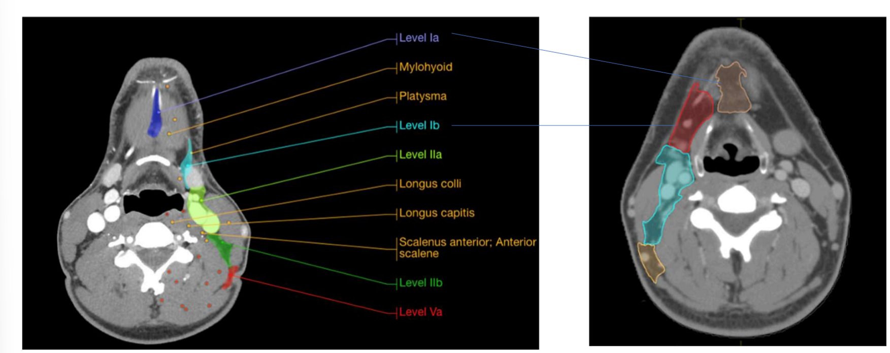 <p>what is the sup and inf border of level IA - submental</p>