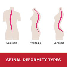 <p>Meaning: bent backward</p><p>Example: lordosis (abnormal increase in the forward curvature of the lumbar spine (the lower back))</p>