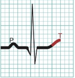 <p>T waves = Repolar of ventricular contractile fibers</p>