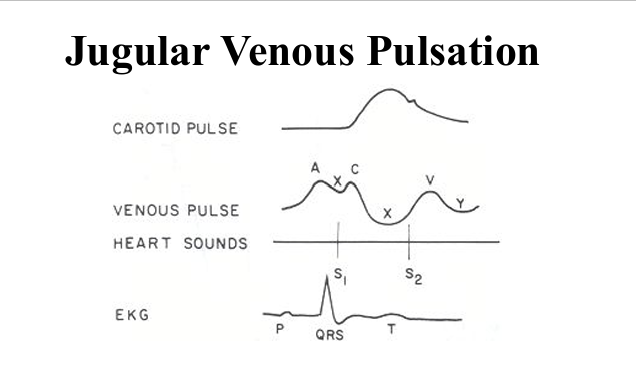 <p>Q: What does the “v wave” represent on the JVP waveform?</p><img src="https://assets.knowt.com/user-attachments/97e58006-21c3-43cc-b510-844b2e045dcc.png" data-width="50%" data-align="center" alt="knowt flashcard image" style="display: block; width: 50%; margin-left: auto; margin-right: auto;"><p></p>